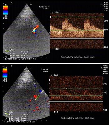 Electroacupuncture Improves Cerebral Vasospasm and Functional Outcome of Patients With Aneurysmal Subarachnoid Hemorrhage